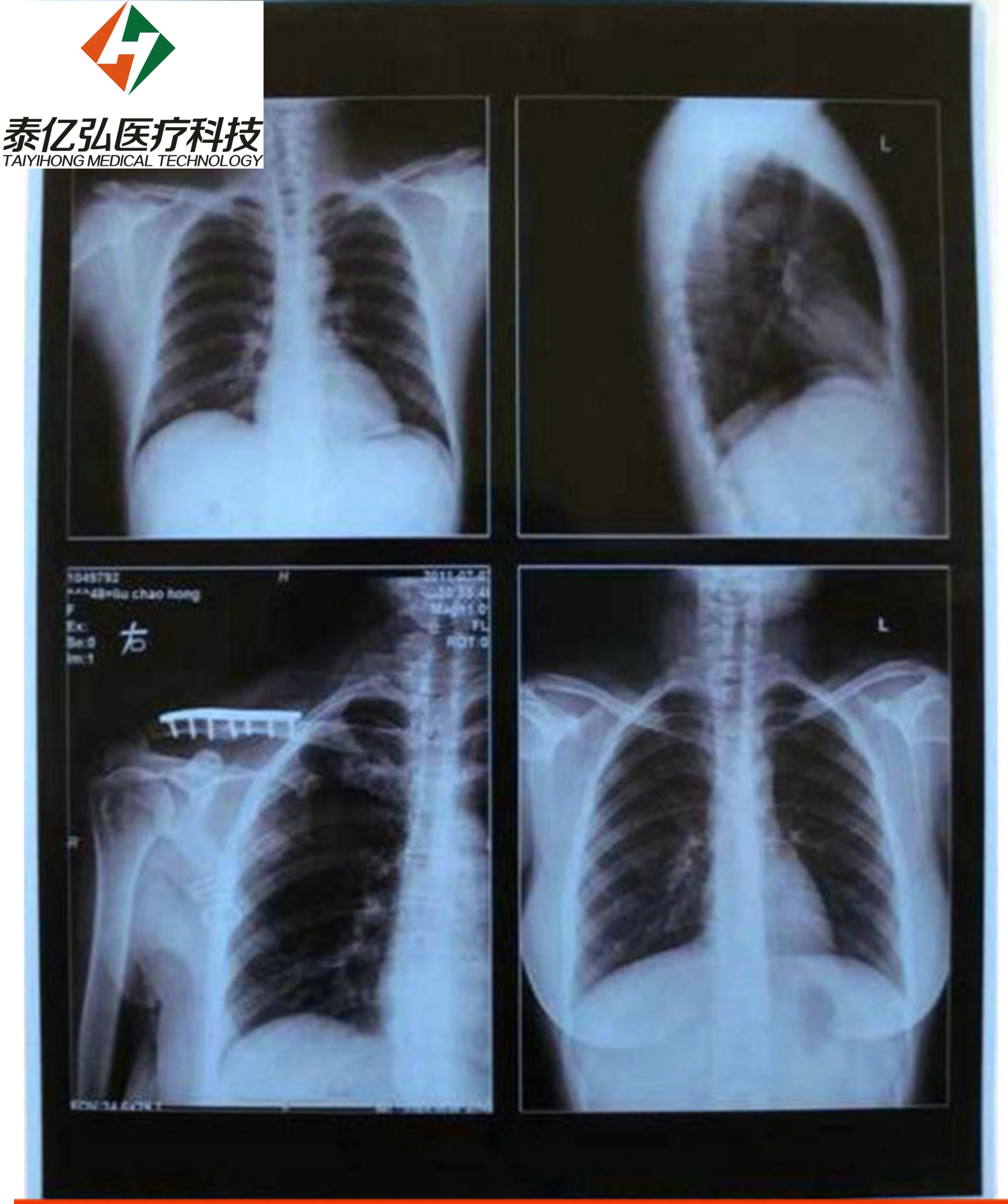 防水防曝光医用胶片喷墨蓝片超声图片