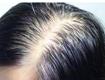 重慶植發(fā)多少錢？ 重慶哪里有不錯的植發(fā)*？