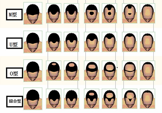 植發(fā)一個(gè)單位多少錢？圖片