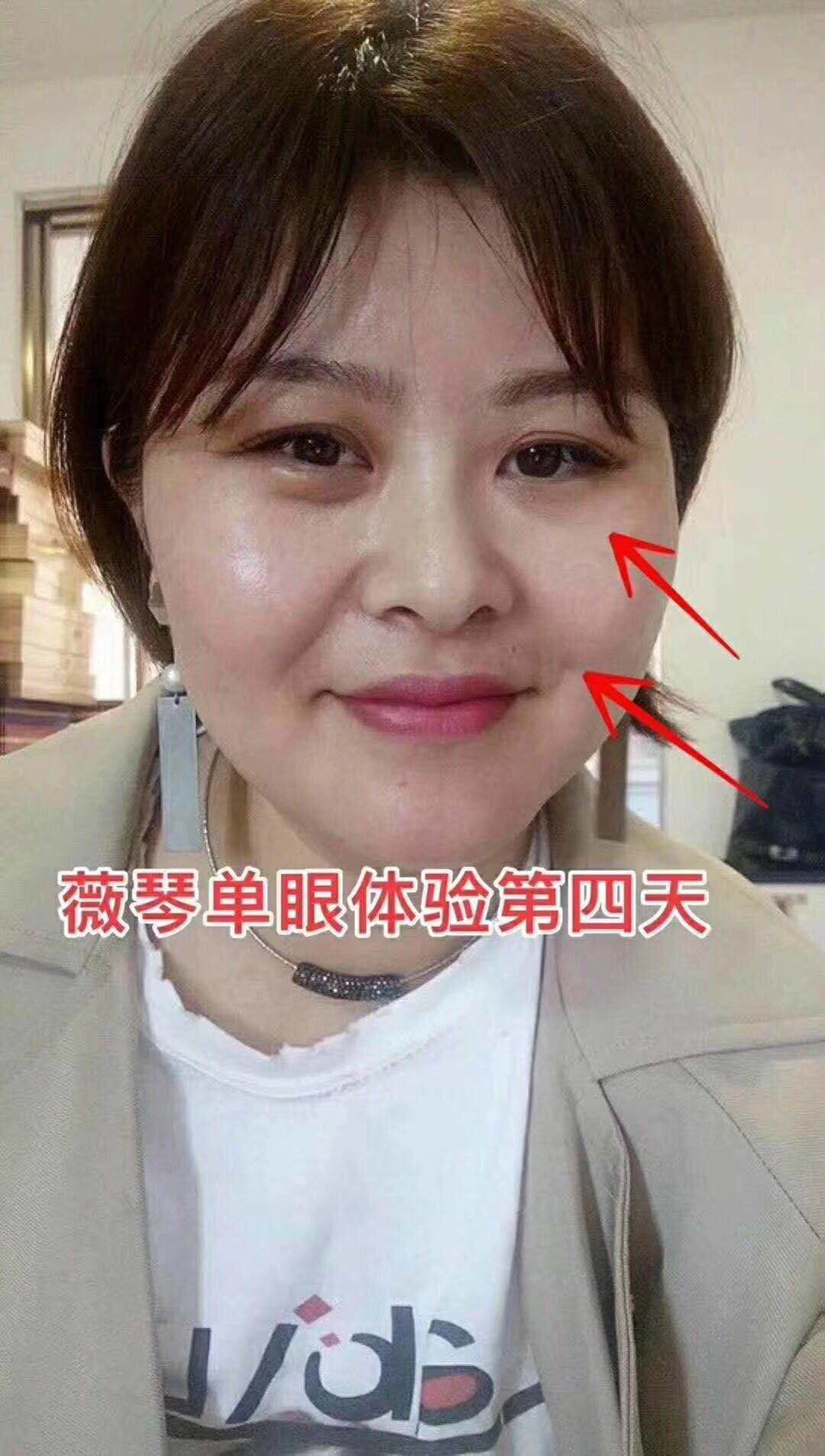 去皺抗衰圖片/去皺抗衰樣板圖 (4)