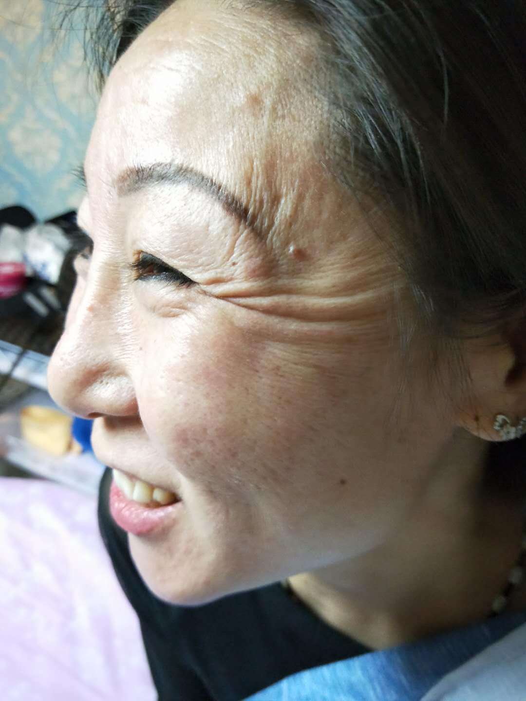 薇琴去皺效果怎么樣安全不安全圖片