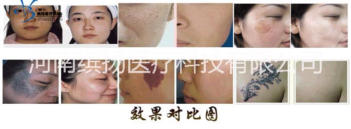 YAG光電調(diào)Q激光美容儀器圖片/YAG光電調(diào)Q激光美容儀器樣板圖 (3)