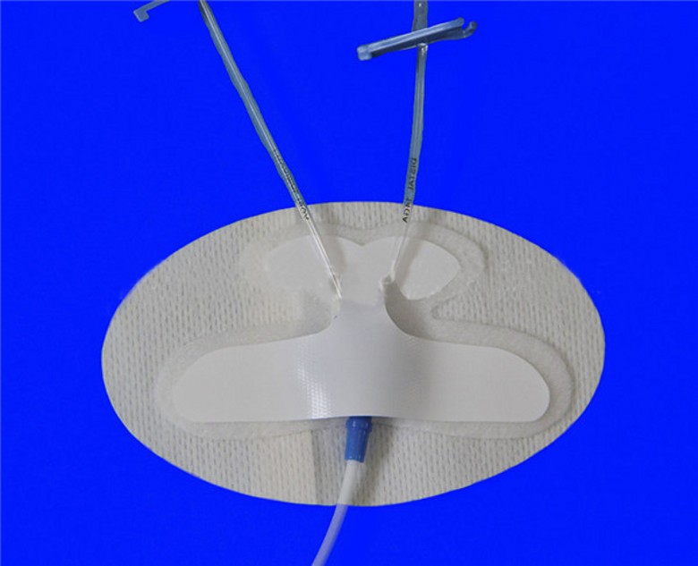 導(dǎo)管固定圖片/導(dǎo)管固定樣板圖 (3)