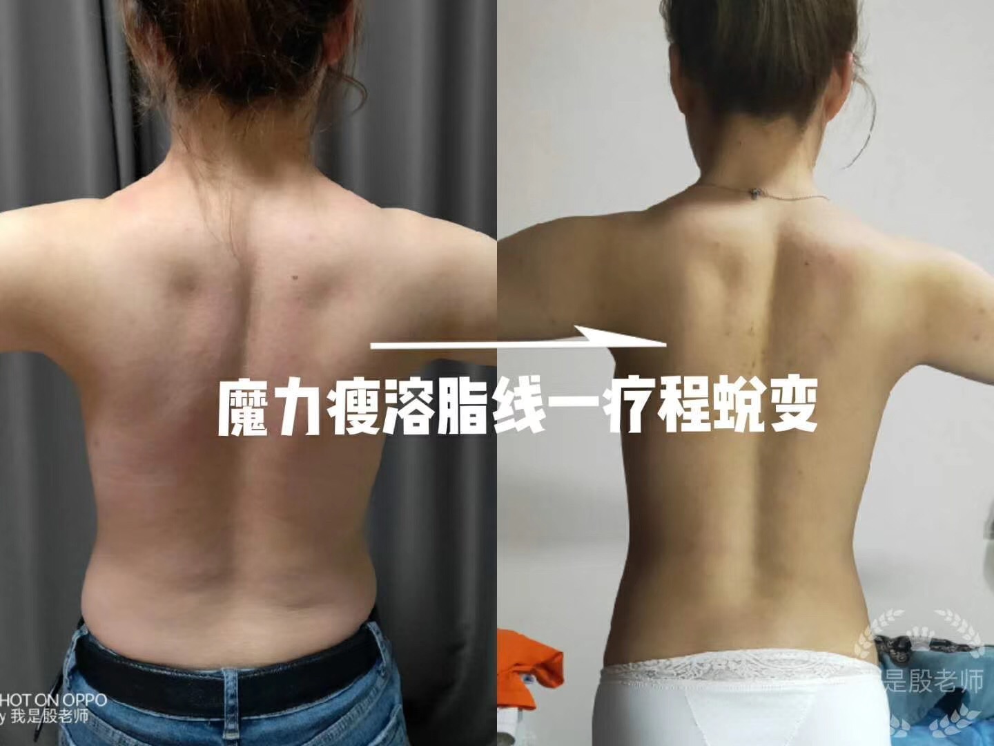 美利貞溶脂線 瘦身 纖體圖片/美利貞溶脂線 瘦身 纖體樣板圖 (2)