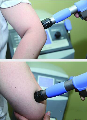 進口沖擊波疼痛zhiliao儀圖片