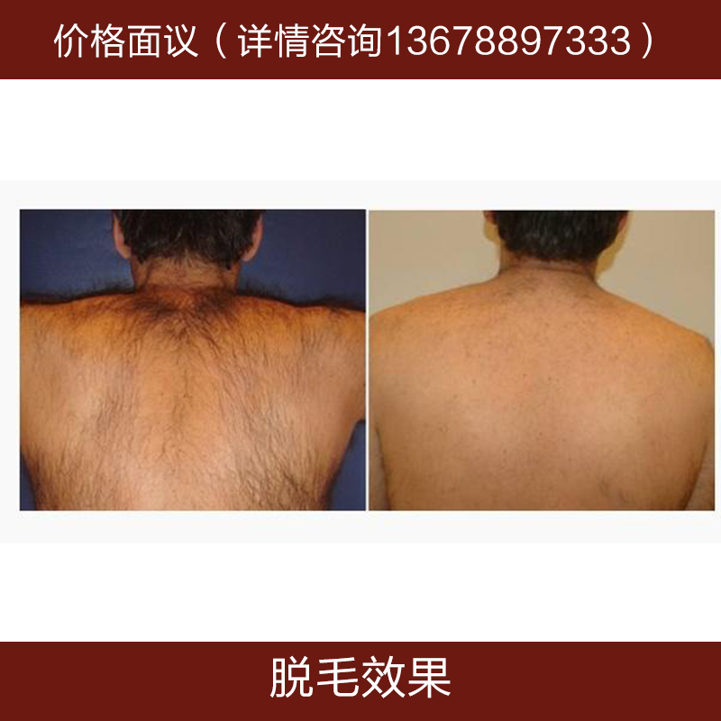 供應(yīng)脫毛效果 *脫毛 美容美體 激光脫毛 脫毛培訓(xùn) 脫毛報(bào)價(jià)