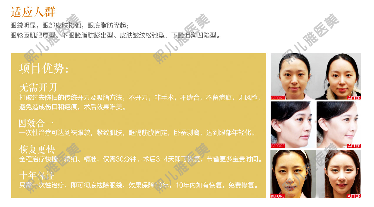 熙兒雅無痕祛眼袋,讓你年輕十歲 5D無痕祛眼袋