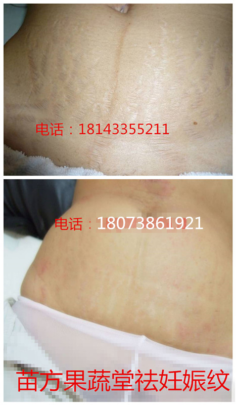 *去除用什么品牌好 湖南苗方果蔬堂*痕修復(fù)精華