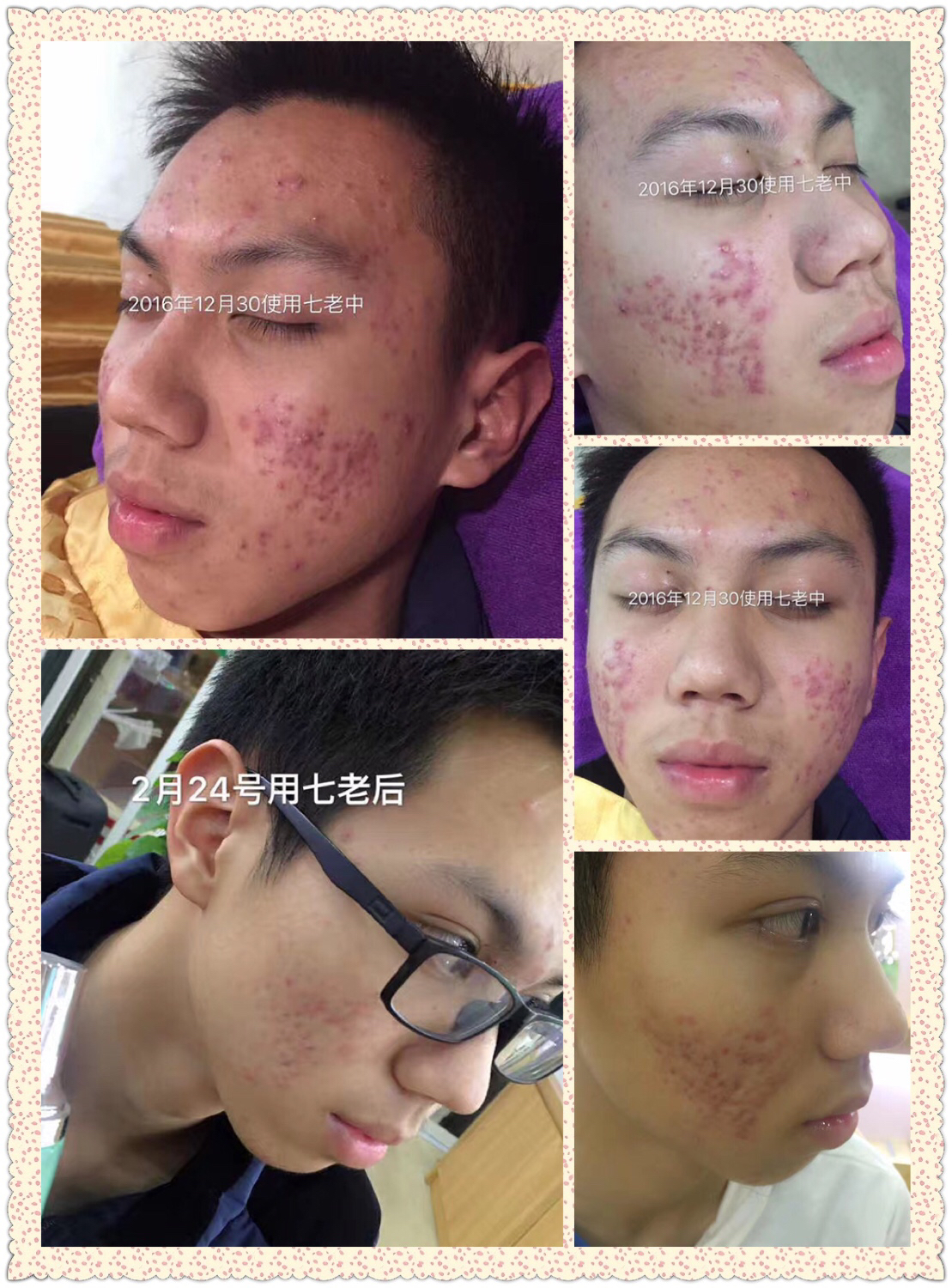 七老護(hù)膚品祛痘效果好嗎,七老護(hù)膚 七老總經(jīng)銷(xiāo)燕子 七老怎么代理