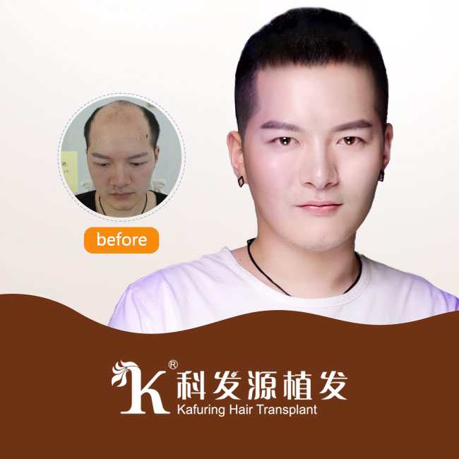 種植頭發(fā)的價(jià)格