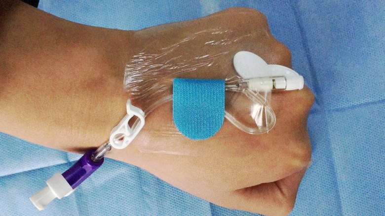 一次性體表導管固定裝置,導管固定器 體表導管固定裝置,留置針固定裝置