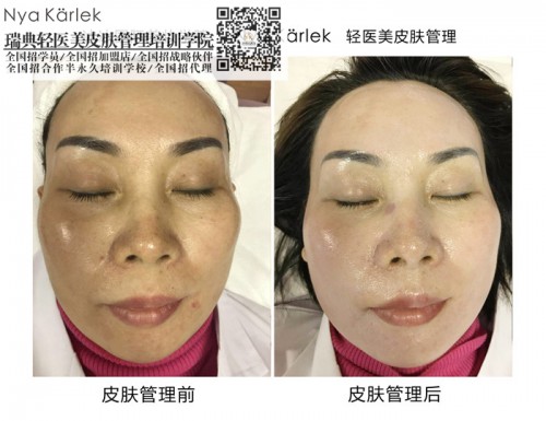 瑞典nk輕醫(yī)美怎_杭州瑞典NKNK*套價格加盟培訓(xùn)