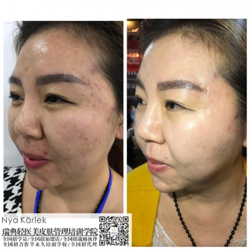 瑞典nk輕醫(yī)美怎_杭州瑞典NKNK*套價格加盟培訓(xùn)