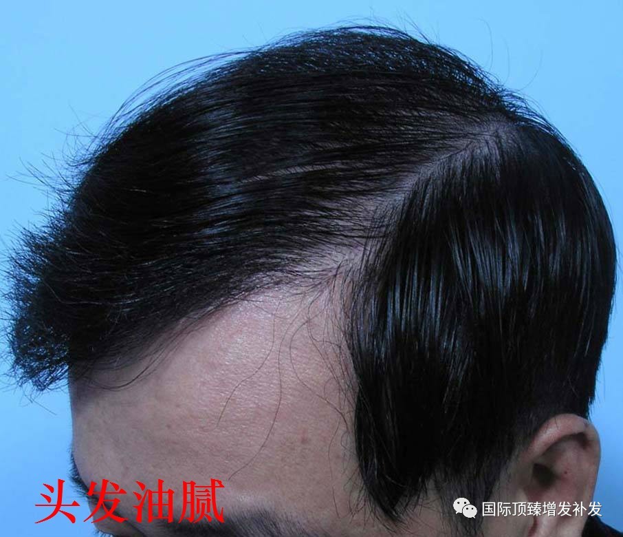 國際頂臻：*醫(yī)美增發(fā)補發(fā)