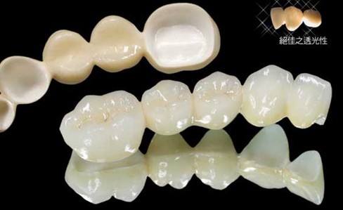 牙齒縫隙問(wèn)題該怎么解決？齒哈尼牙齒貼面美白，牙齒美容