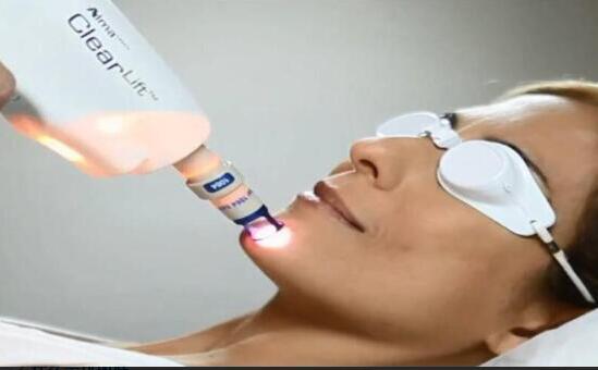 可麗膚ClearLift激光嫩膚儀
